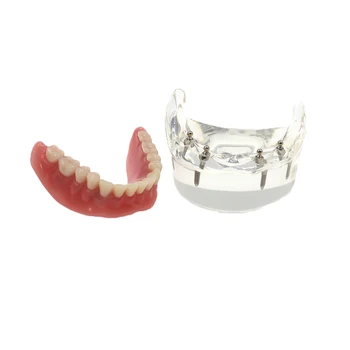 Dantų Implantai, Dantų Modelio Demo Overdenture Restauravimas su 4Lower Implantai